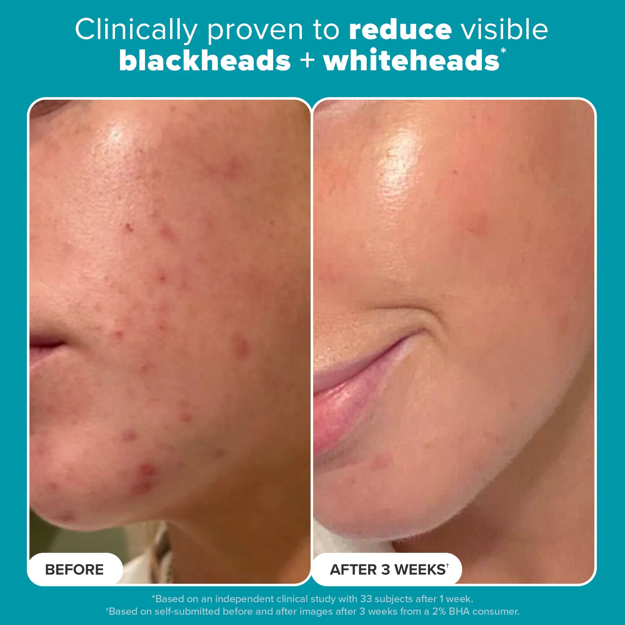 Skin Perfecting 2% BHA Exfoliating Toner for Clear Skin