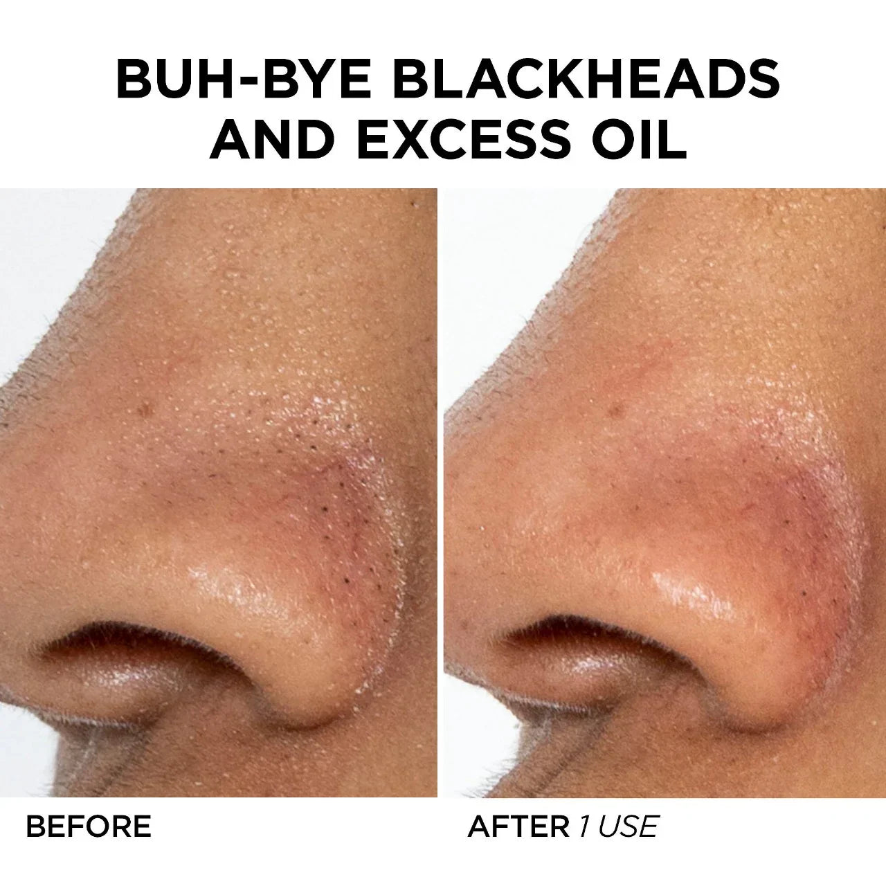 GLOfacial Hydro-Infusion Pore Cleansing + Blue LED Clarifying Tool