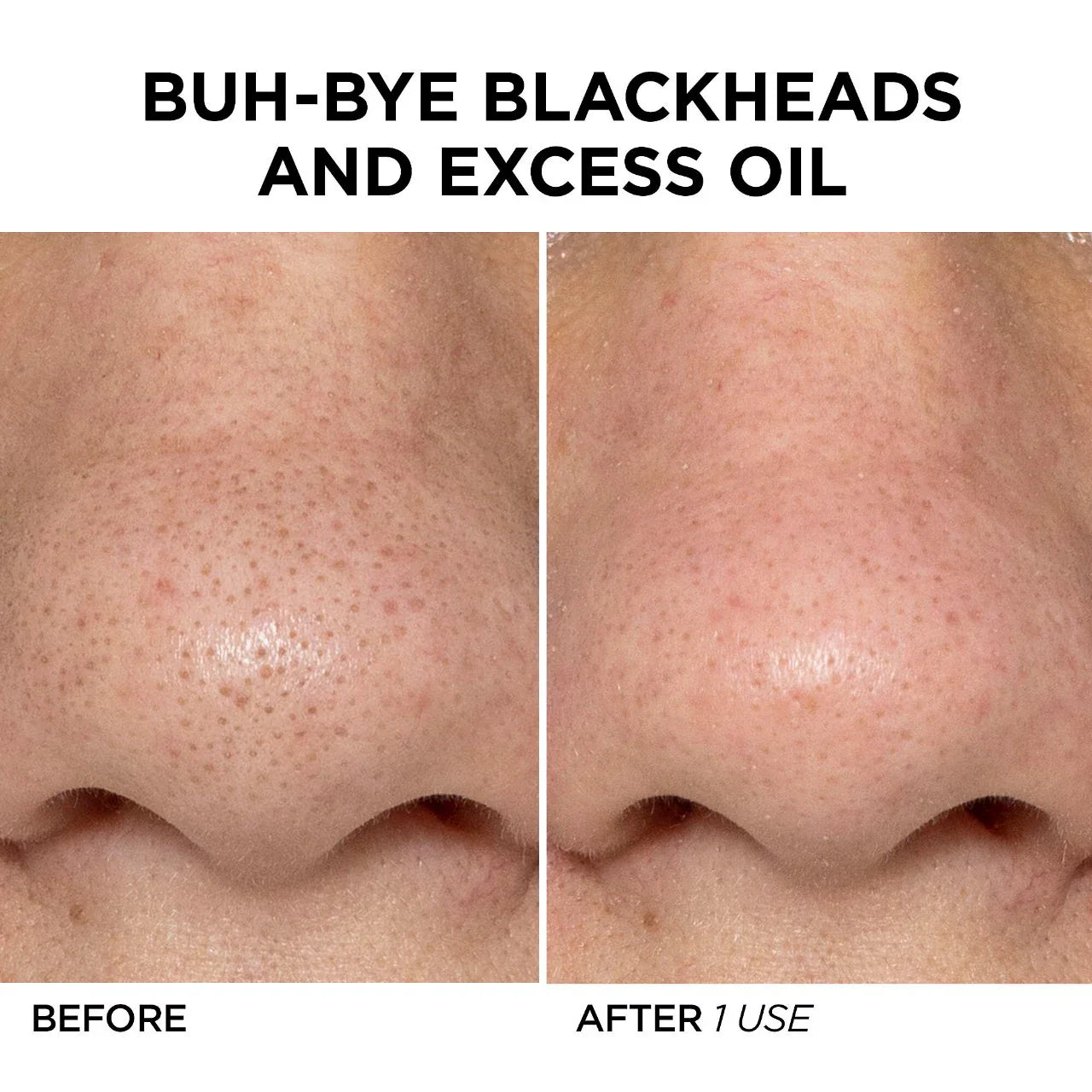 GLOfacial Hydro-Infusion Pore Cleansing + Blue LED Clarifying Tool