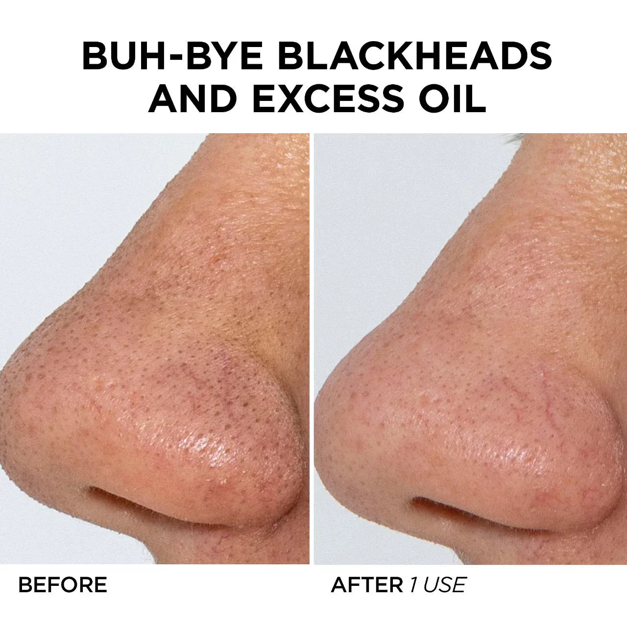 GLOfacial Hydro-Infusion Pore Cleansing + Blue LED Clarifying Tool