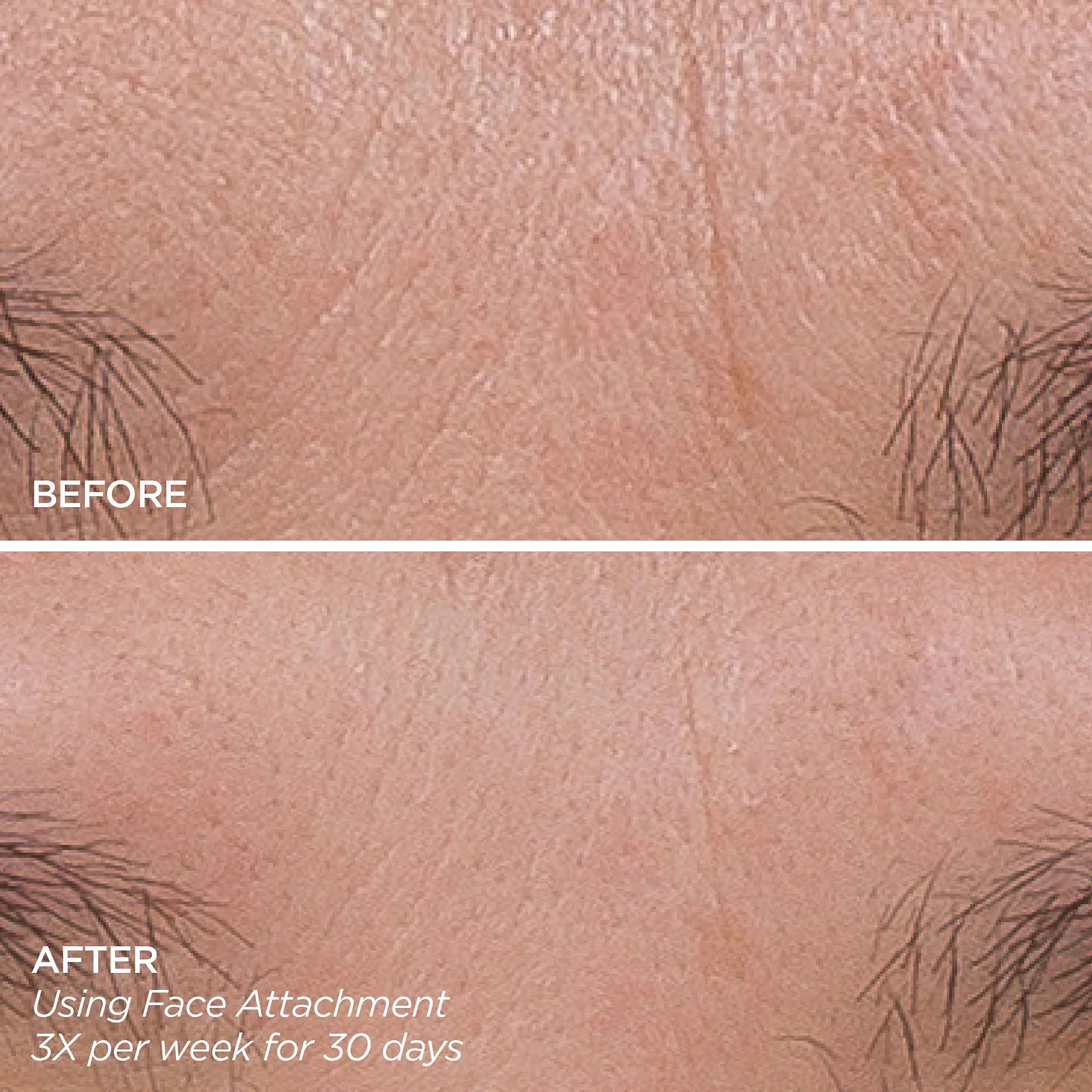 Get That Glow - GloPRO® Microneedling Tool & Discovery Set