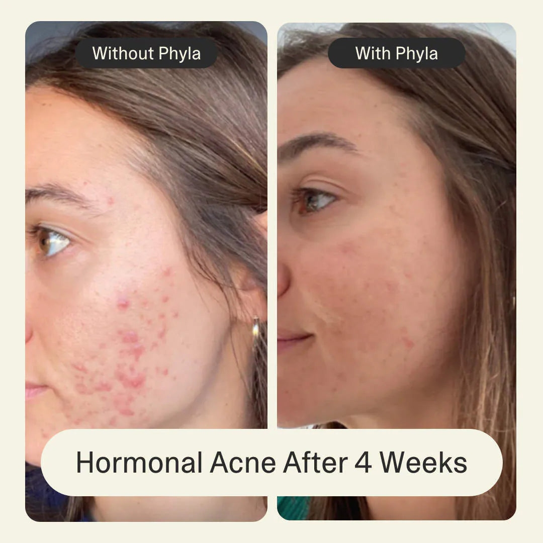 Acne Phage System
