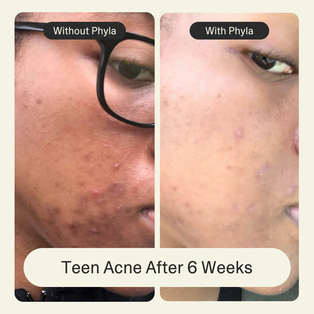 Acne Phage System