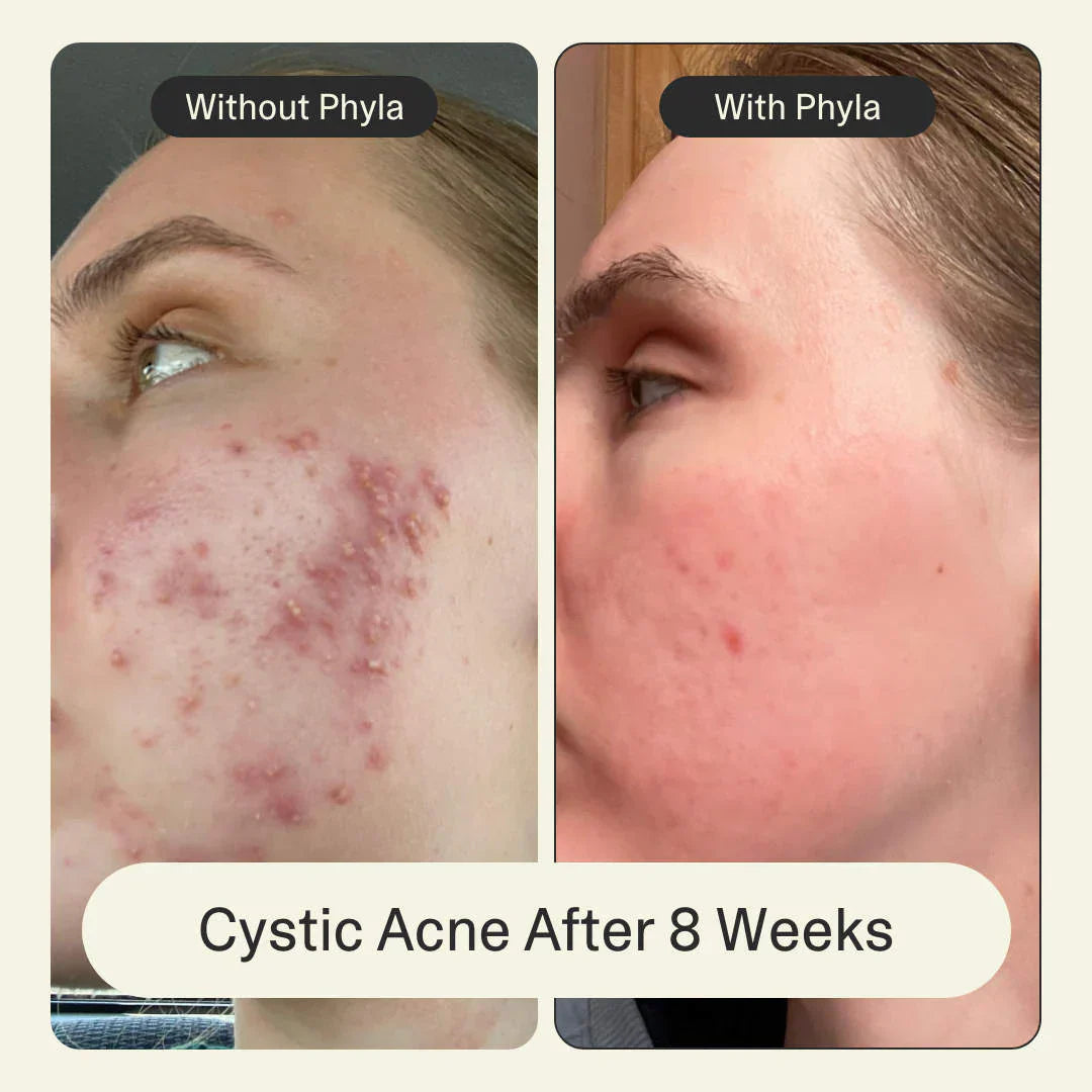 Acne Phage System
