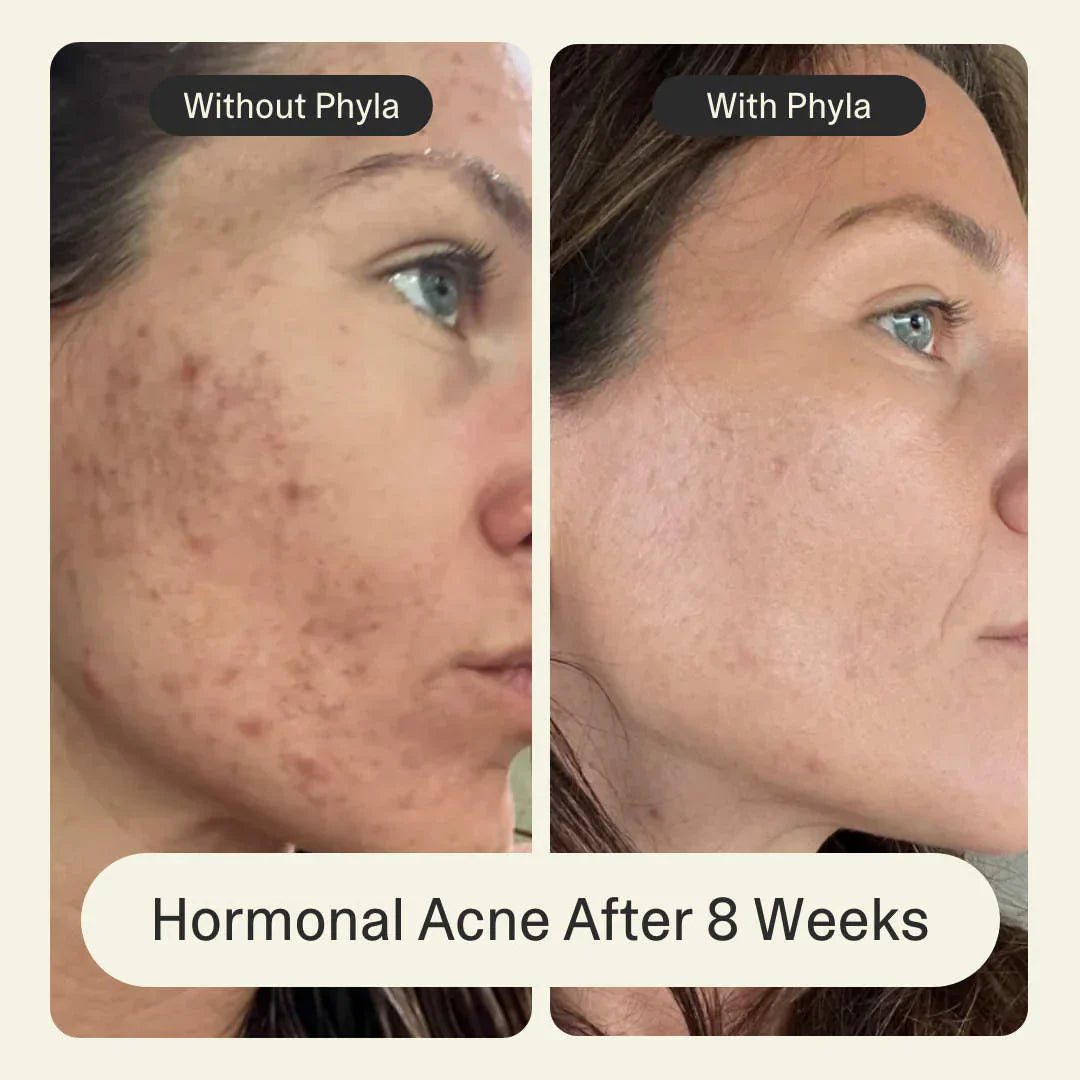 Acne Phage System