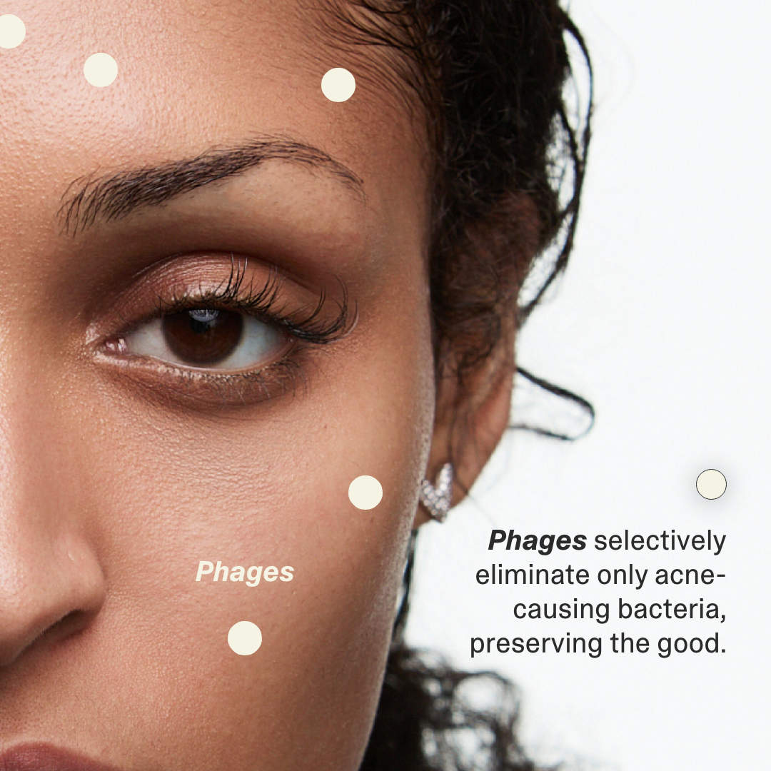 Acne Phage System
